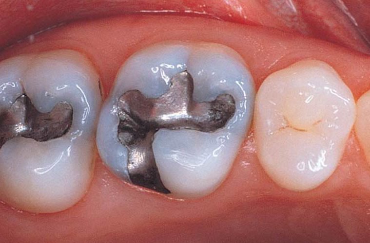 dentists-explain-how-dangerous-mercury-fillings-amalgams-are-what