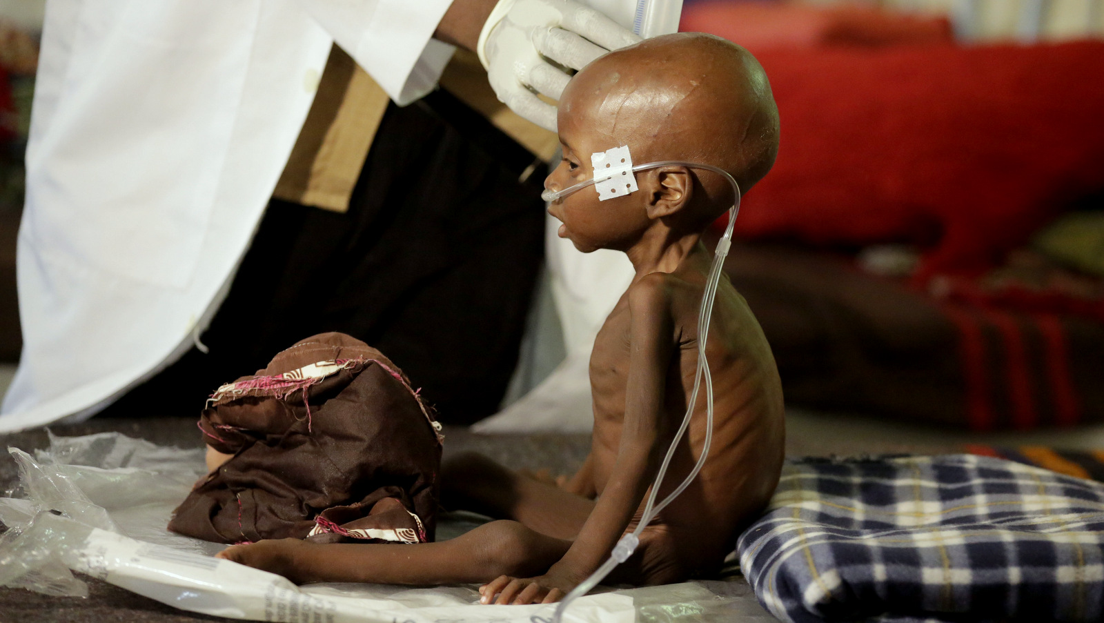 A malnourished child receives heath care at a feeding center run by Doctors Without Borders in Maiduguri Nigeria. The U.N. Security Council on Friday, March. 3, 2017 kicked off a visit to spotlight Africa's worst humanitarian crisis as millions face hunger amid the Boko Haram insurgency in Nigeria and the Lake Chad region, Aug. 29, 2016. (AP/Sunday Alamba)