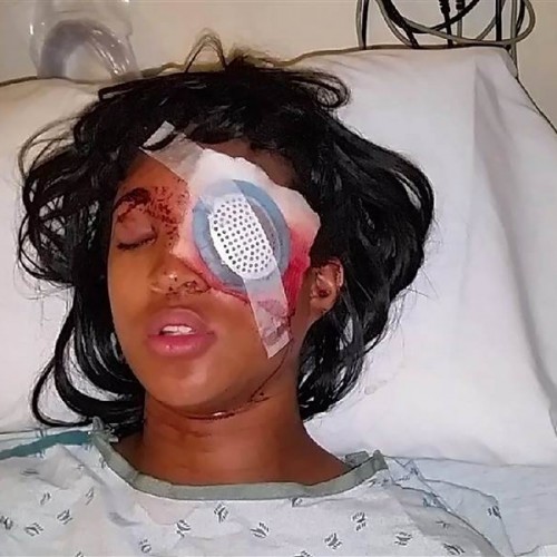 Pregnant Mother Loses Her Eye After Ferguson Cop Opens Fire on Her With High-Velocity Bean Bag Round